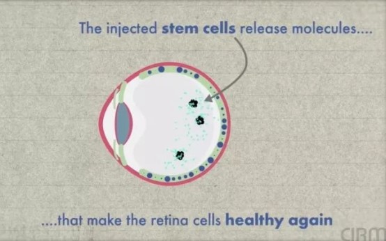 干细胞治疗眼部疾病