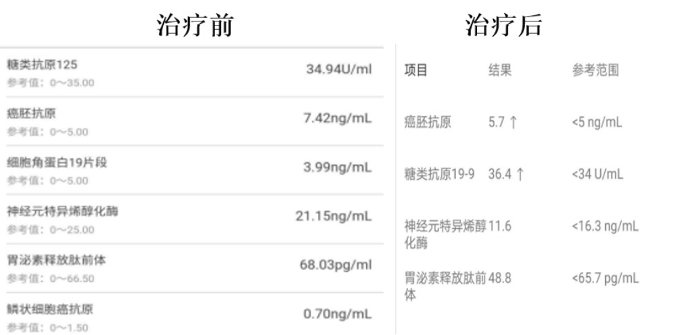 癌症的免疫细胞治疗