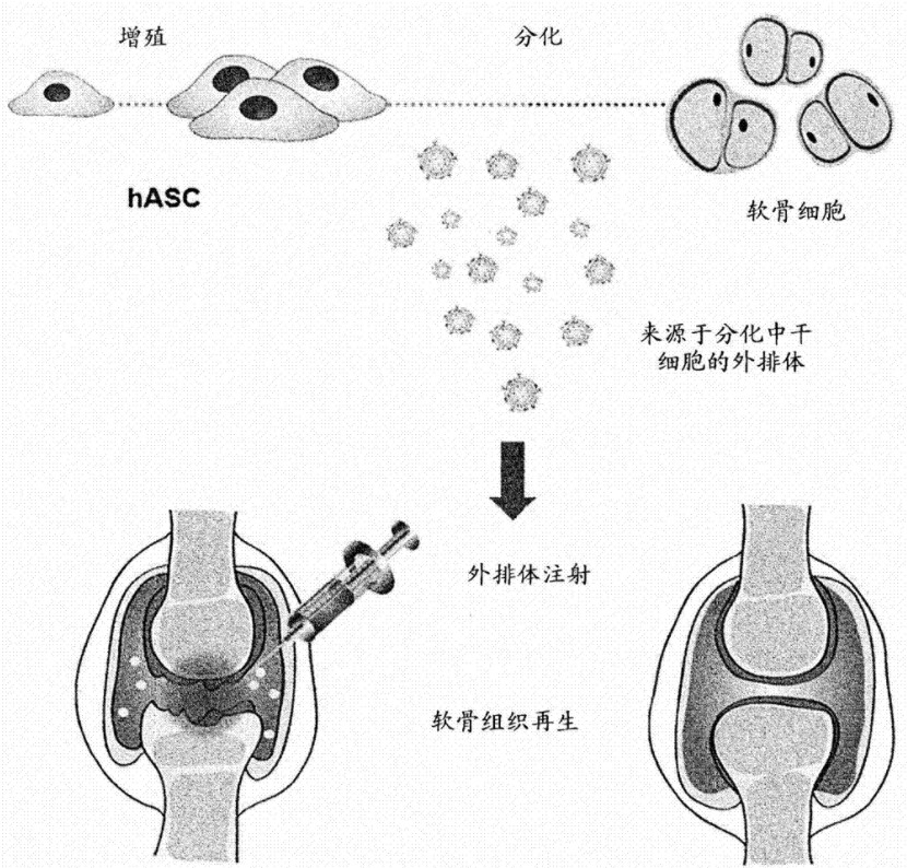 干细胞修复关节炎-关节软骨再生