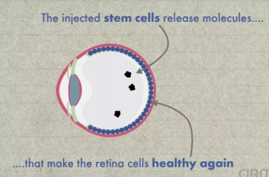 干细胞治疗眼部疾病