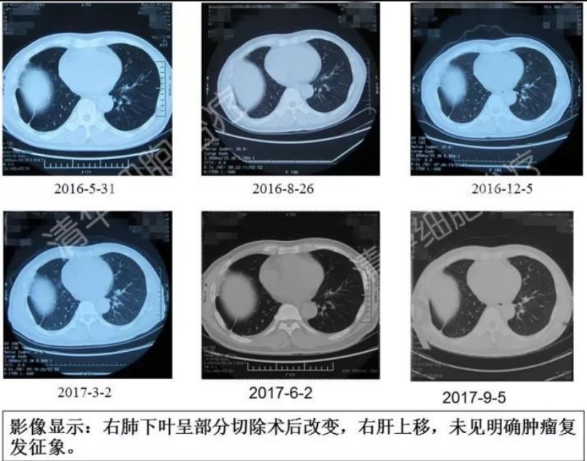 癌症的免疫细胞治疗