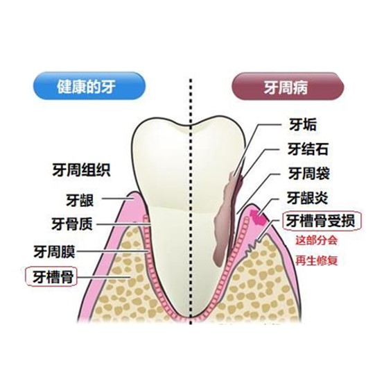 间充质干细胞-治疗牙龈萎缩