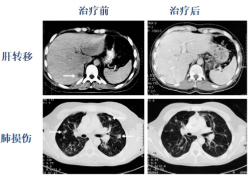 癌症的免疫细胞治疗