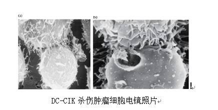 癌症的免疫细胞治疗