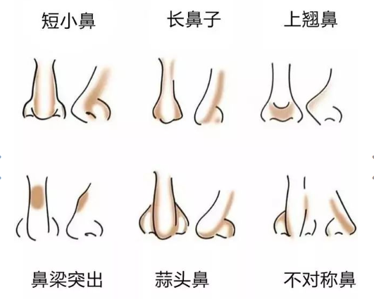 石家庄市半肋骨隆鼻膨体医生哪一位好?