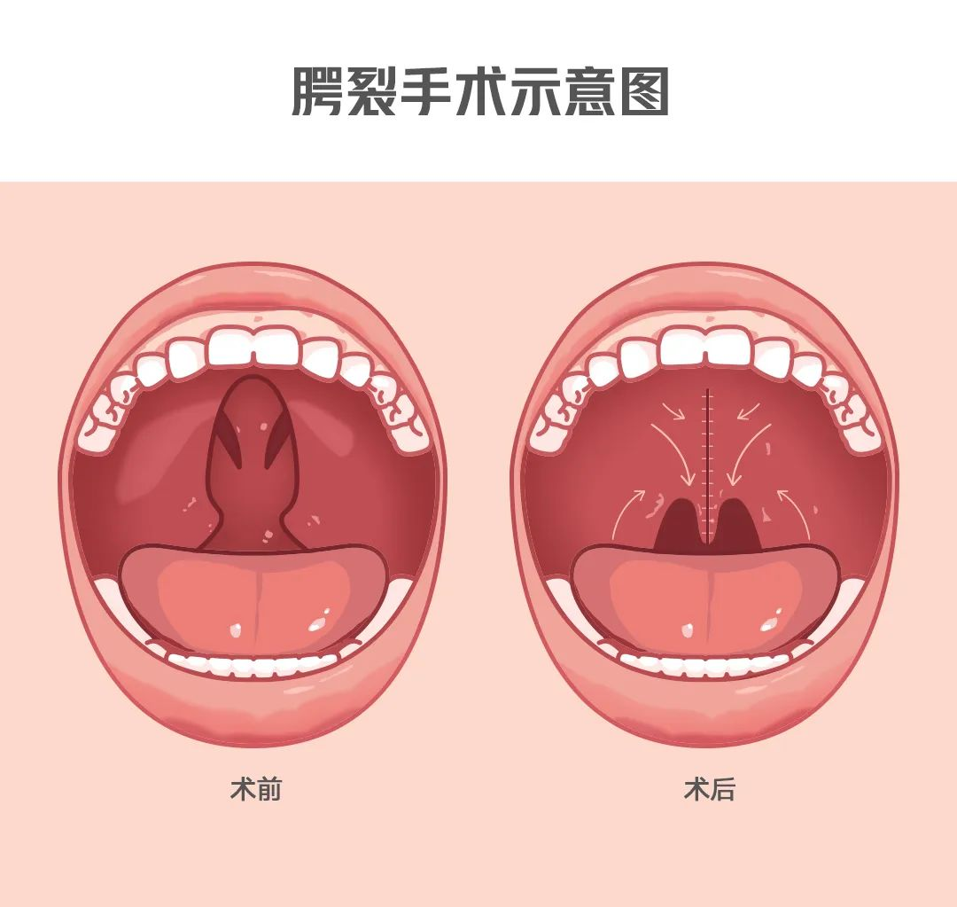 遵义市唇腭裂手术矫正这五位医生实力出众！