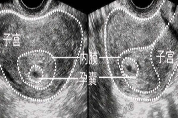 超声检查下的孕囊情况