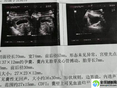 腺肌症子宫十厘米试管成功