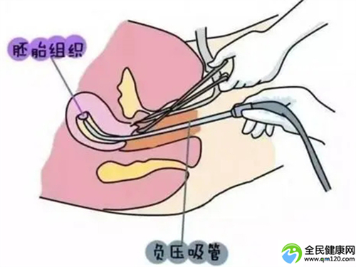 泰国三代试管费用明细揭秘