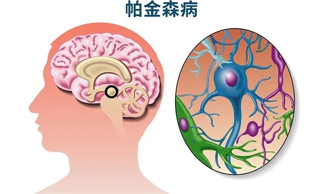 利用诱导多能干细胞（iPSCs）攻克帕金森的故事