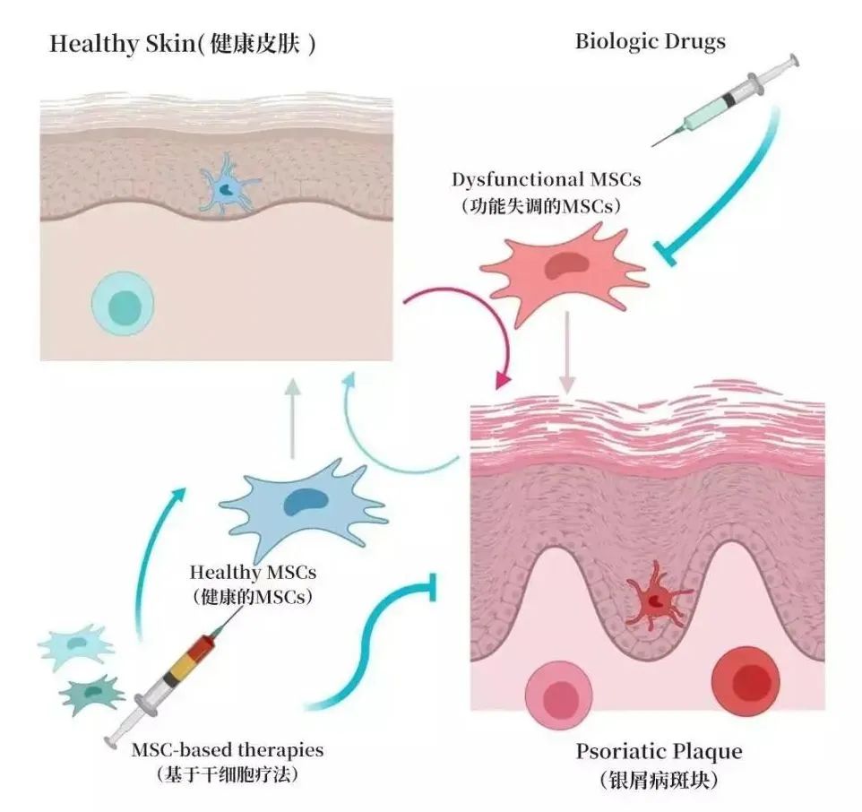 临床结果表明，干细胞治疗银屑病有效率高达67%！
