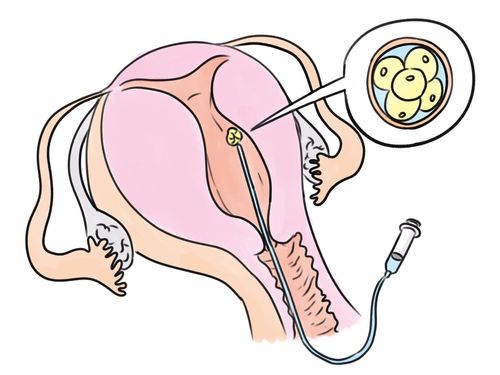 子宫内膜增生紊乱试管成功率高吗子宫内膜增生紊乱影响试管移植吗