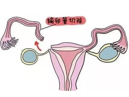 从成都去格鲁吉亚做试管一般要多少钱