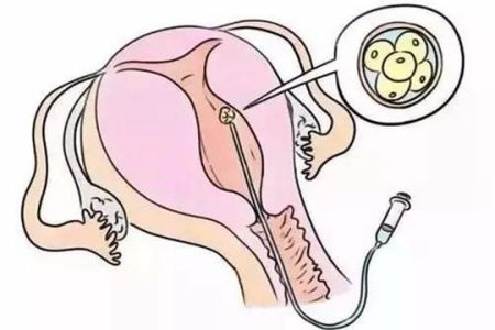 男方无精子症做第三代试管婴儿要多少钱？