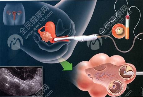 在宁波三代试管移植冻囊胚没有辅助孵化怎么办?