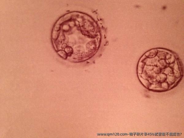 精子碎片率45%试管能不能成功?