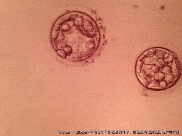 有梅毒能不能做试管怀孕，梅毒患者试管风险及解决方案