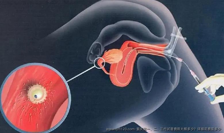 重庆做一、二、三代试管费用大概多少？详细花费是多少