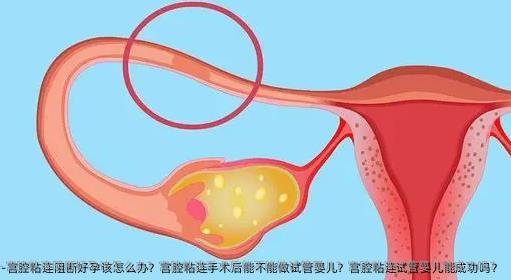 宫腔粘连阻断好孕该怎么办？宫腔粘连手术后能不能做试管婴儿？宫腔粘连试管婴儿能成功吗？