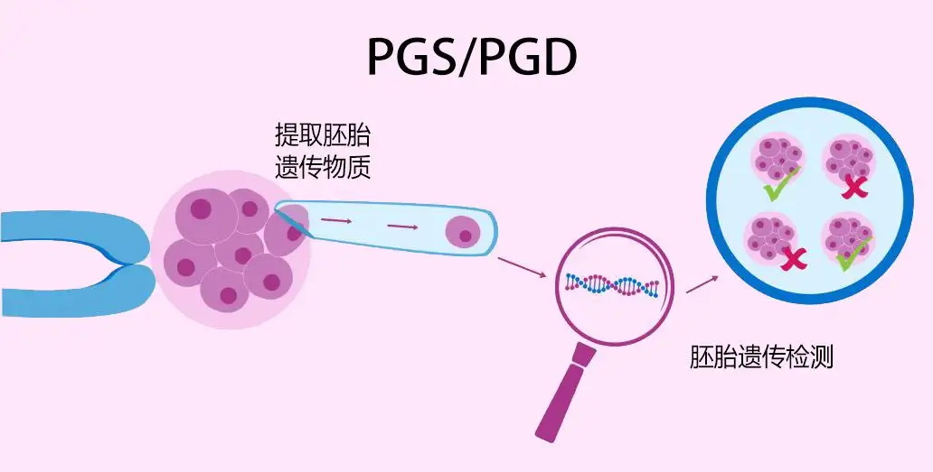 解读试管助孕中胚胎移植方式与成功率关系