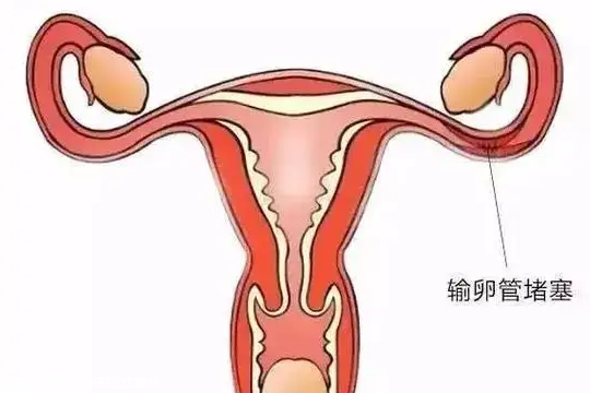 卵巢多囊综合征试管可以吗，卵巢多囊综合症可以做试管婴儿吗