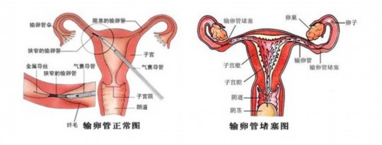 单角子宫试管婴儿流程是什么？