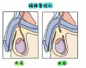 衡水输卵管切除多少钱？