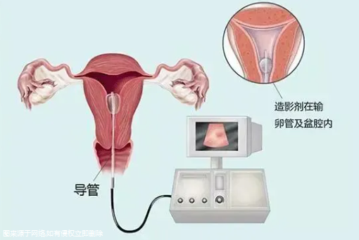 输卵管被切除能做试管吗-女性输卵管被切除能做试管吗