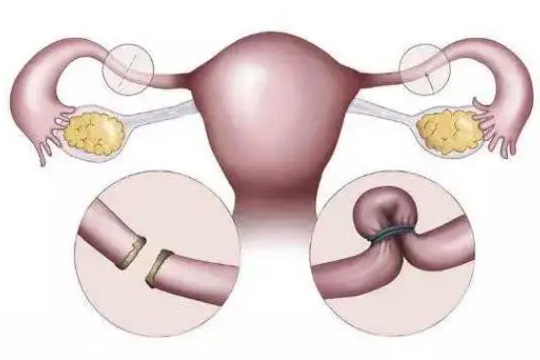 输卵管切除试管失败怎么办 输卵管切除了试管还会宫外孕吗