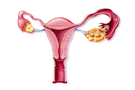 多囊卵巢综合症要试管吗？多囊卵巢综合症需要试管婴儿吗？