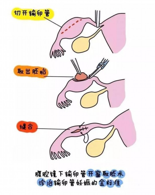 卵巢囊肿试管可以吗 卵巢囊肿试管一般用什么方案