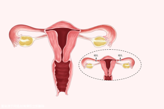 女生结扎了还可以试管吗 女人结扎了还能试管婴儿吗