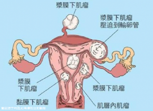 宫颈炎能引起月经不调(月经不调会引起什么)