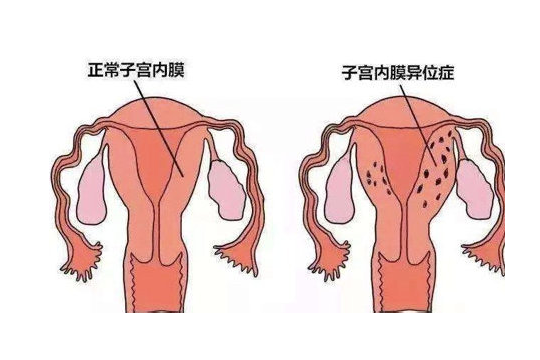 结扎后是复通好还是试管好-结扎过后复通生育几率多少