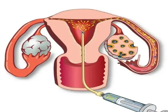 有盆腔粘连可以试管吗？女性有盆腔粘连可以试管吗？