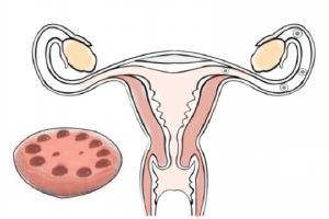 异常出血盆腔炎可以试管吗？女异常出血盆腔炎可以试管吗？