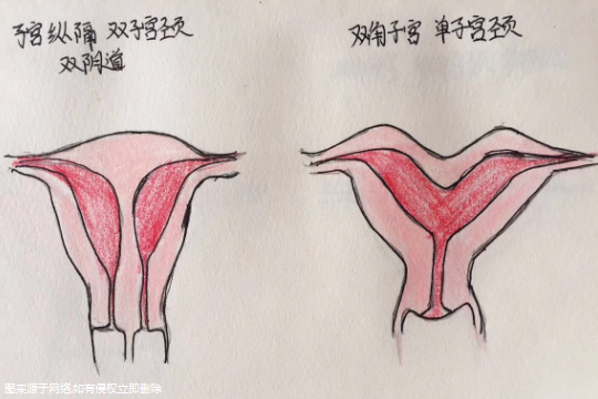 宫腔分离修复后多久可以试管移植