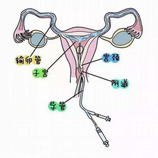 宫腔积血试管移植怎么办