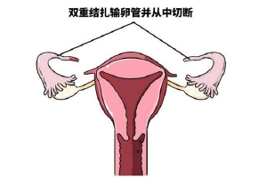 女性已经结扎可以做试管吗？女性已结扎可以做试管婴儿吗？