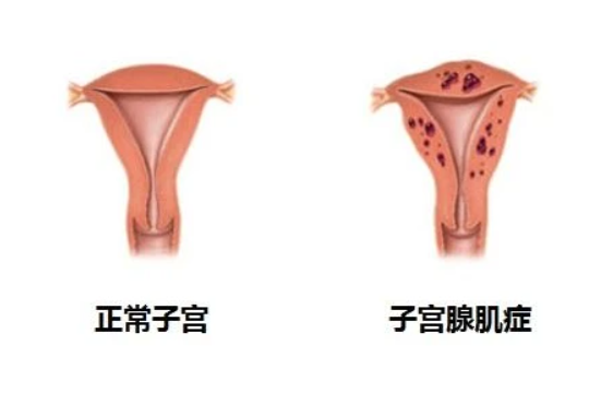 宫腔内钙化点可以做试管吗？女性宫腔内钙化点可以做试管吗？