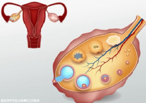 输卵管积水做试管大概多久成功，输卵管积水做试管怎么办