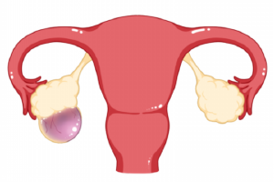 卵巢囊肿做试管会影响吗-卵巢囊肿能不能试管