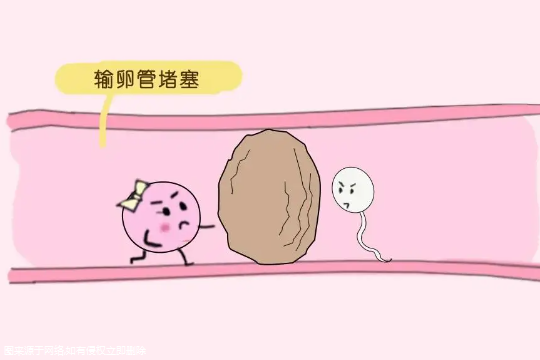 盆腔异位症可以试管吗？女性盆腔异位症可以试管吗？