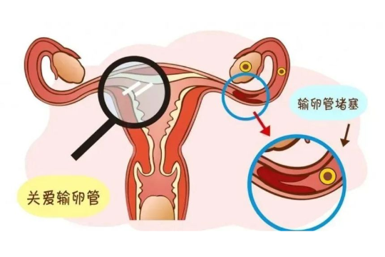 多囊卵巢综合征怎样做试管？多囊卵巢做试管的步骤