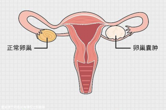 子宫内膜异位试管能不能一次怀上？