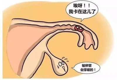 输卵管粘连