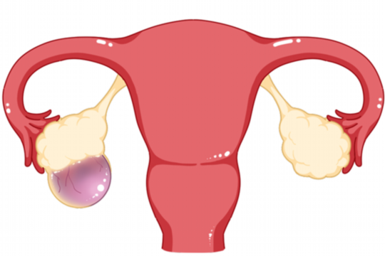 卵巢囊肿