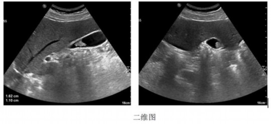 二维彩超