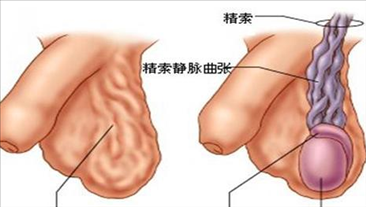 精索静脉曲张