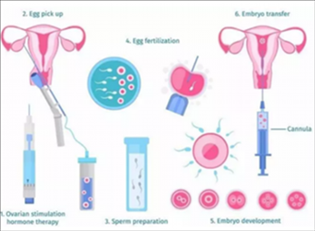 试管婴儿的具体步骤